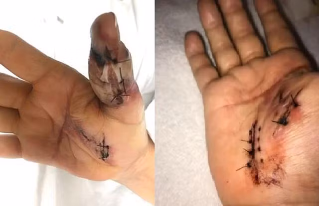 Suyt mat mang vi nhiem virus an thit khi di lam mong tay-Hinh-2