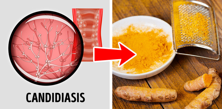 5. Tăng cường ăn nghệ trong điều trị nhiễm trùng: Củ nghệ chứa chất chống oxy hóa mạnh mẽ và đặc tính chống viêm. Tuy nhiên, nó cũng nổi tiếng với hoạt tính kháng nấm, kháng khuẩn và kháng vi-rút. Vì vậy, người ta cho rằng nghệ có thể là một phương pháp điều trị hiệu quả chống lại nấm candida.