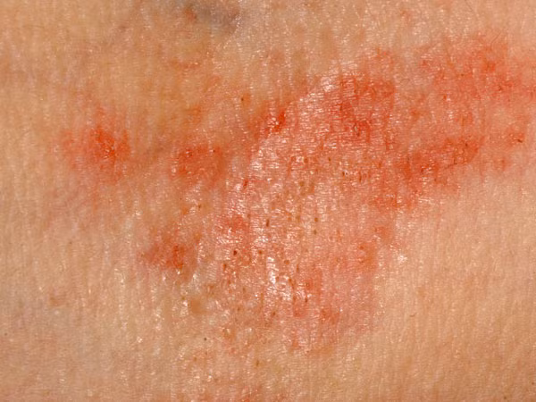 Dễ lở loét: Xuất hiện nhiều vết lở loét trong miệng lâu không lành là biểu hiện đáng lo ngại về sức khỏe, cảnh báo nguy cơ bị ung thư. Ngoài ra, những người có sự biến đổi về màu sắc quanh các vết thương như xuất hiện một số mảng trắng, đỏ hoặc xanh cũng thuộc nhóm những người có nguy cơ cao bị ung thư.