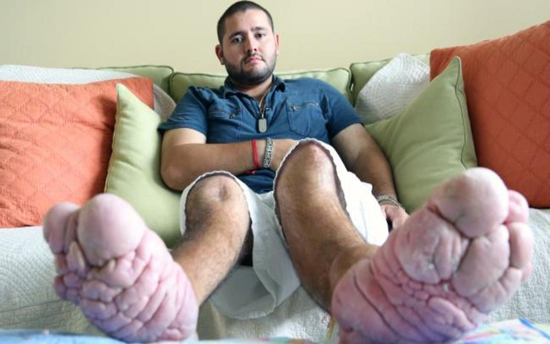 Hội chứng Proteus: Còn được gọi là hội chứng Wiedemann, đặc trưng bởi tình trạng xương phát triển lệch lạc khiến cho các bàn tay, bàn chân có hình dáng không bình thường. Các biện pháp điều trị hiện vẫn đang được nghiên cứu ứng dụng.