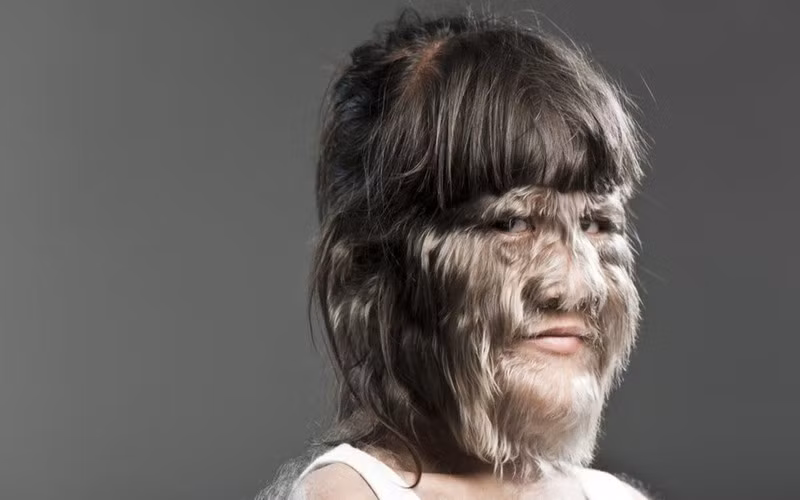 Hội chứng người sói: Do bất thường về gene nên tình trạng mọc lông không được kiểm soát dẫn đến tình trạng lông mọc dài, rậm toàn thân hoặc ở một số nơi của cơ thể như mặt, tay, lưng...