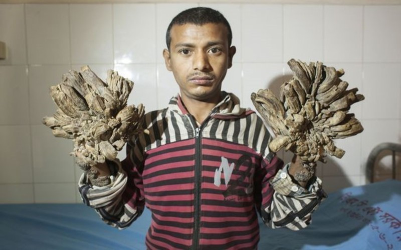 Hội chứng người cây: Nguyên nhân của bệnh là do một virus thuộc họ HPV (Human Papillomavirus) gây ra. Tổn thương là các nốt, các mảnh chai sần như vỏ cây mọc trên mặt hoặc các đầu chi. Bệnh không gây tử vong tuy nhiên ảnh hưởng rất nhiều tới thẩm mỹ và cản trở các hoạt động hàng ngày của bệnh nhân.