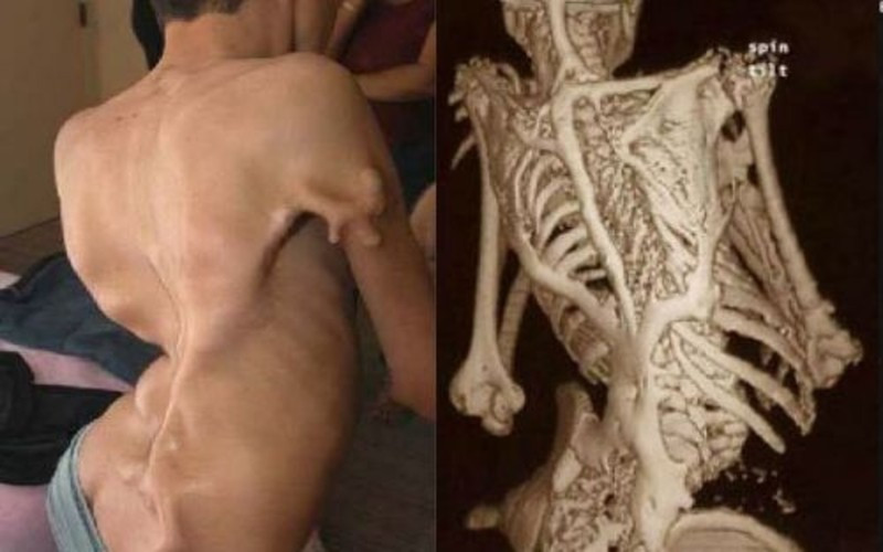 Hội chứng xương hóa đá: Đột biến gene khiến dẫn đến tình trạng xơ - vôi hóa tổ chức liên kết toàn thân tiến triển khiến cho cơ thể xơ cứng, vặn vẹo như một bức tượng sống. Hiện chưa có điều trị hiệu quả cho chứng bệnh này.