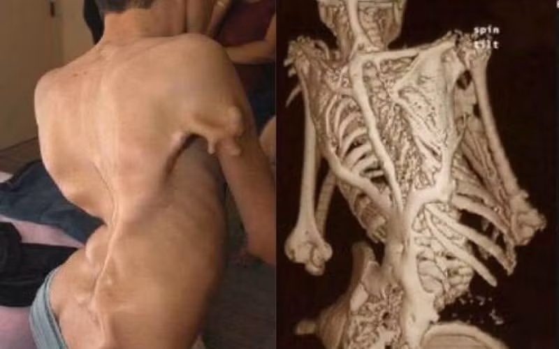 Hội chứng xương hóa đá: Đột biến gene khiến dẫn đến tình trạng xơ - vôi hóa tổ chức liên kết toàn thân tiến triển khiến cho cơ thể xơ cứng, vặn vẹo như một bức tượng sống. Hiện chưa có điều trị hiệu quả cho chứng bệnh này.