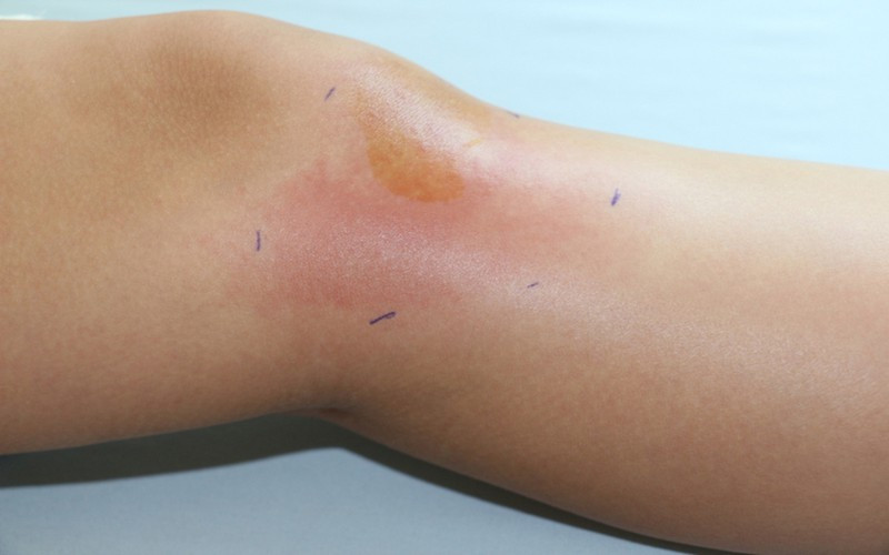 Viêm mô hoại tử: Còn được gọi là bệnh vi khuẩn ăn thịt người, flesh-eating disease là một căn bệnh hiếm gặp do một số loại vi khuẩn gây nên trong đó liên cầu khuẩn nhóm A, có thể gây tử vong trong vòng 24 giờ và tỷ lệ tử vong lên tới trên 70%.