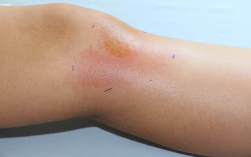 Viêm mô hoại tử: Còn được gọi là bệnh vi khuẩn ăn thịt người, flesh-eating disease là một căn bệnh hiếm gặp do một số loại vi khuẩn gây nên trong đó liên cầu khuẩn nhóm A, có thể gây tử vong trong vòng 24 giờ và tỷ lệ tử vong lên tới trên 70%.