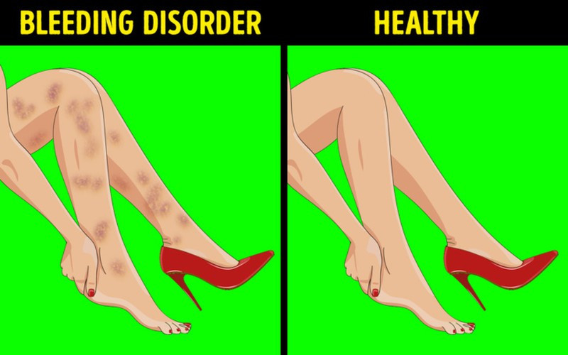 Xuất hiện những vết bầm tím không rõ nguyên nhân: Nếu các đốm thâm tím hoặc xanh xuất hiện ngẫu nhiên mà không có bất kỳ nguyên nhân do va đập nào và lưu lại trong một thời gian dài trên da, thì đó có thể là dấu hiệu cảnh báo về bệnh gan, viêm mạch máu, rối loạn mạch máu...