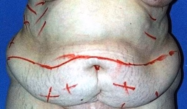 Nin tho theo doi ca phau thuat cat 7kg da, mo thua cho ba me beo phi-Hinh-2