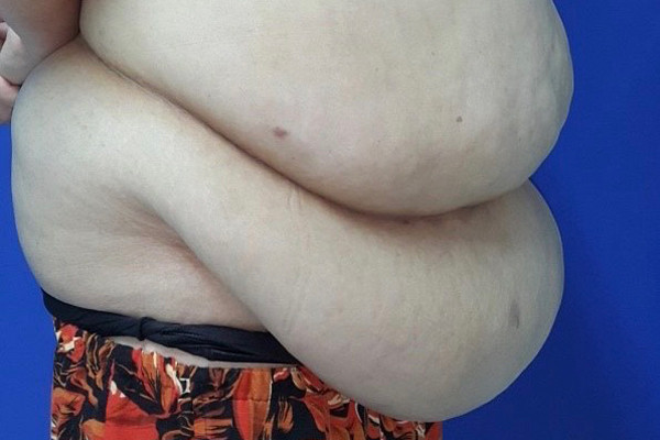 Nin tho theo doi ca phau thuat cat 7kg da, mo thua cho ba me beo phi