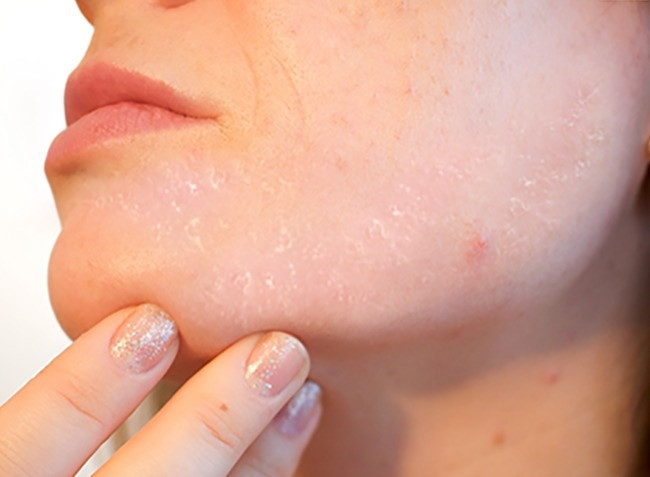 Bong tróc da: Đây là dấu hiệu cho thấy cơ thể bạn thiếu vitamin. Chế độ ăn uống cân bằng có thể giúp làn da trở lại trạng thái bình thường. Nhưng nếu bong tróc kèm theo ngứa, bạn có thể bị nhiễm nấm.