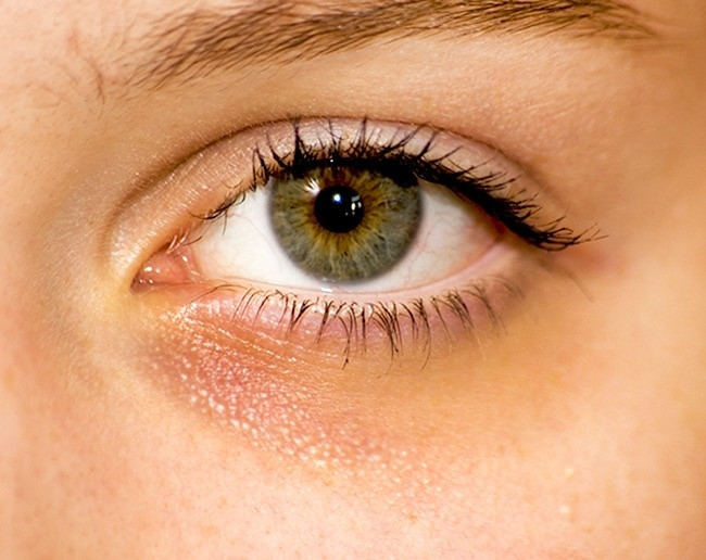 Quầng thâm dưới mắt: Nếu bạn không ngủ đủ giấc, quầng thâm dưới mắt sẽ xuất hiện. Theo Medical News Today, các bác sĩ khuyên mỗi đêm bạn nên ngủ không ít hơn 7-8 giờ. Tuy nhiên, quầng thâm dưới mắt cũng là dấu hiệu của bệnh thiếu máu. Khi đó, cơ thể không sản xuất đủ tế bào hồng cầu, vùng da dưới mắt sẽ bị thâm quầng.