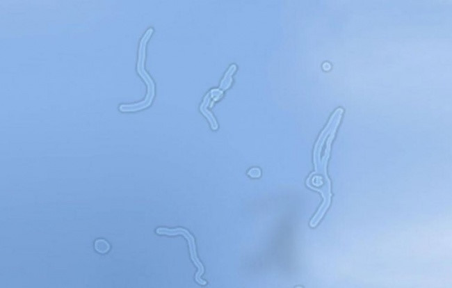 Xuất hiện nhiều đốm ở trước mắt: Chúng có thể là dấu chấm hoặc vệt, dải trong suốt. Chúng xuất hiện đột ngột và thường xuyên khi mắt tiếp xúc với ánh sáng. Nếu điều này xuất hiện hơn một tuần, bạn nên tham khảo ý kiến của bác sĩ nhãn khoa. Đây có thể là dấu hiệu sớm của đục thủy tinh thể hoặc các vấn đề về thị lực khác.