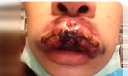 Nếu sử dụng mực xăm đểu có nguồn gốc Trung Quốc, mực xăm rẻ tiền chứa hóa chất độc hại được các cơ sở thẩm mỹ quy mô nhỏ sử dụng vì tham lợi nhuận, người dùng sẽ gặp phải những nguy cơ bị xăm môi hỏng và có thể ảnh hưởng đến hình dáng môi nếu tình trạng nhiễm trùng nặng do không giữ vệ sinh và được điều trị kịp thời. 