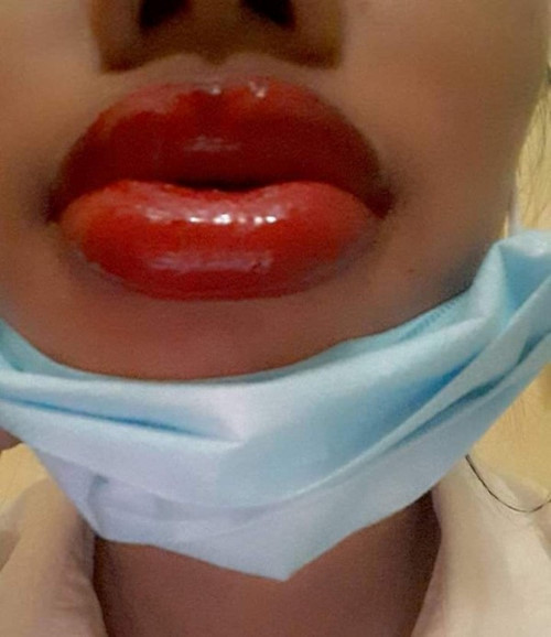 Đôi môi sưng tều sau khi xăm khiến nhiều người cảm thông nhưng vẫn không thể nhịn cười. Không biết những ngày sau đó, đôi môi này của cô gái có bớt sưng, có trở lại xinh đẹp hay không nhưng quả thật, nhìn đôi môi khi mới xăm này, ai cũng lắc đầu ngao ngán.