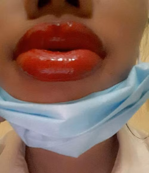 Đôi môi sưng tều sau khi xăm khiến nhiều người cảm thông nhưng vẫn không thể nhịn cười. Không biết những ngày sau đó, đôi môi này của cô gái có bớt sưng, có trở lại xinh đẹp hay không nhưng quả thật, nhìn đôi môi khi mới xăm này, ai cũng lắc đầu ngao ngán.