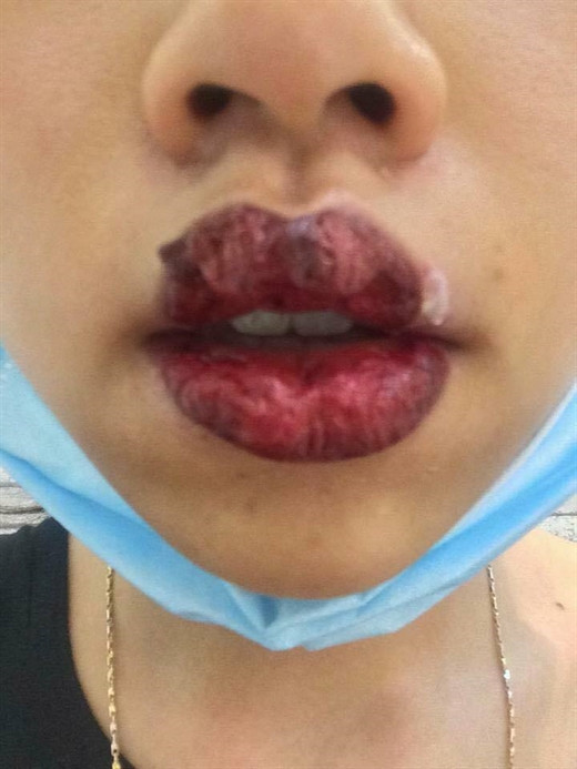 Đối với trường hợp xăm môi bị dị ứng, tình trạng da môi bị dị ứng mực xăm có thể kéo dài vài ngày, vài tuần thậm chí vài tháng khi lớp da bị bong tróc và sưng tấy, có nguy cơ cao bị viêm và mưng mủ. Ảnh: Internet. Video "Bí quyết làm đẹp của sao Việt". Nguồn VTC.