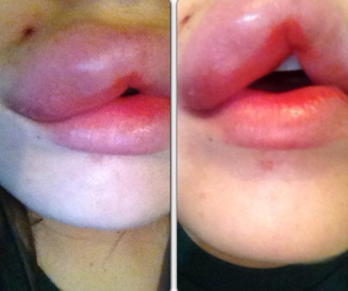 Những trường hợp xăm môi bị hỏng có thể do lựa chọn cơ sở làm đẹp không uy tín, chuyên viên phun xăm không có nhiều kinh nghiệm, tay nghề còn non yếu sẽ khó xử lý tạo được màu môi, viền môi và đường nét dáng môi thẩm mỹ và tự nhiên.