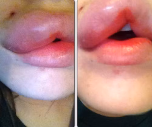 Những trường hợp xăm môi bị hỏng có thể do lựa chọn cơ sở làm đẹp không uy tín, chuyên viên phun xăm không có nhiều kinh nghiệm, tay nghề còn non yếu sẽ khó xử lý tạo được màu môi, viền môi và đường nét dáng môi thẩm mỹ và tự nhiên.