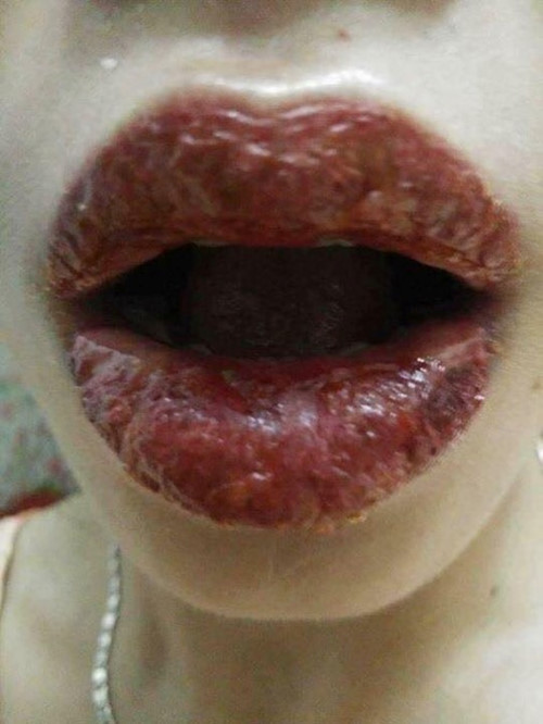 Trên thực tế, có rất nhiều hình ảnh xăm môi thất bại tương tự đã xảy ra. Trước đó, mạng xã hội từng chia sẻ những trường hợp xăm môi hỏng khiến nhiều người ngao ngán.