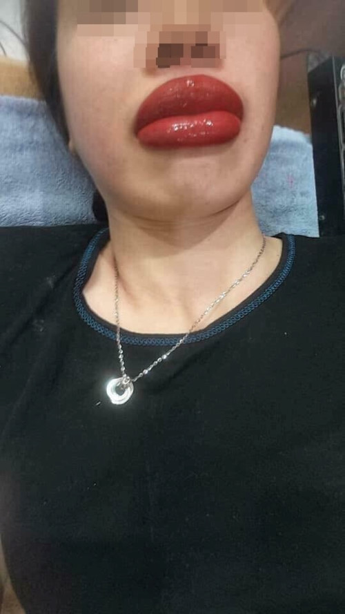 Sau khi tìm đến một cơ sở xăm môi, cô gái nhận về đôi môi sưng tều, màu môi đỏ chót, bóng nhưỡng khiến gương mặt cô mất cân đối, trở nên xấu xí hơn lúc ban đầu.