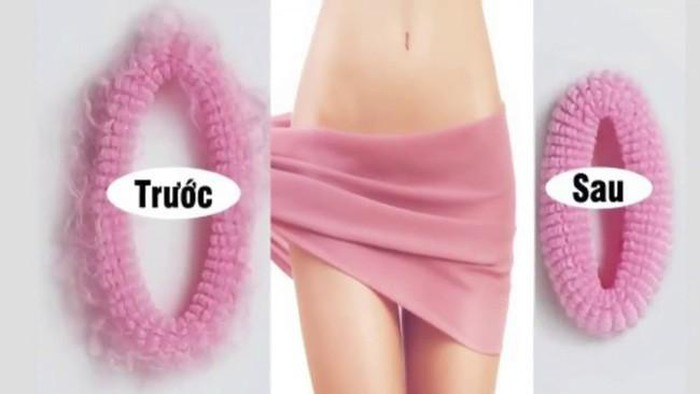 Cai ket dau thuong cho nguoi phu nu lam tham my vung kin-Hinh-3