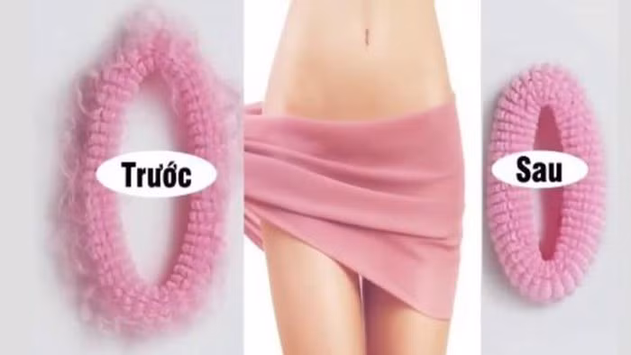 Cai ket dau thuong cho nguoi phu nu lam tham my vung kin-Hinh-3