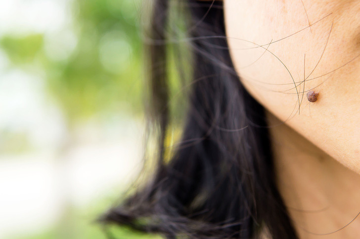  Nốt ruồi xuất hiện khi các tế bào da phát triển thành một nhóm, thay vì dàn trải khắp trên bề mặt da. Nốt ruồi đa phần đều vô hại nhưng đôi lúc, nó cũng có thể là dấu hiệu cảnh báo một số vấn đề của cơ thể, trong đó có ung thư. Bạn hãy theo dõi sự thay đổi của các nốt ruồi để nhận biết sớm các bất thường trong cơ thể.