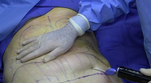 Điển hình như trường hợp bác sĩ Đinh Viết Hưng ở bệnh viện thẩm mỹ Emcas dù chưa có chứng chỉ về phẫu thuật thẩm mỹ nhưng vẫn thực hiện hút mỡ bụng cho các khách hàng. Ông Hưng chính là người chỉ định hút mỡ bụng cho một phụ nữ mang thai 2 tháng. Trước đó, tháng 4/2019, một phụ nữ ở Phú Thọ cũng tử vong khi đi hút mỡ bụng tại bệnh viện An Việt (Hà Nội).