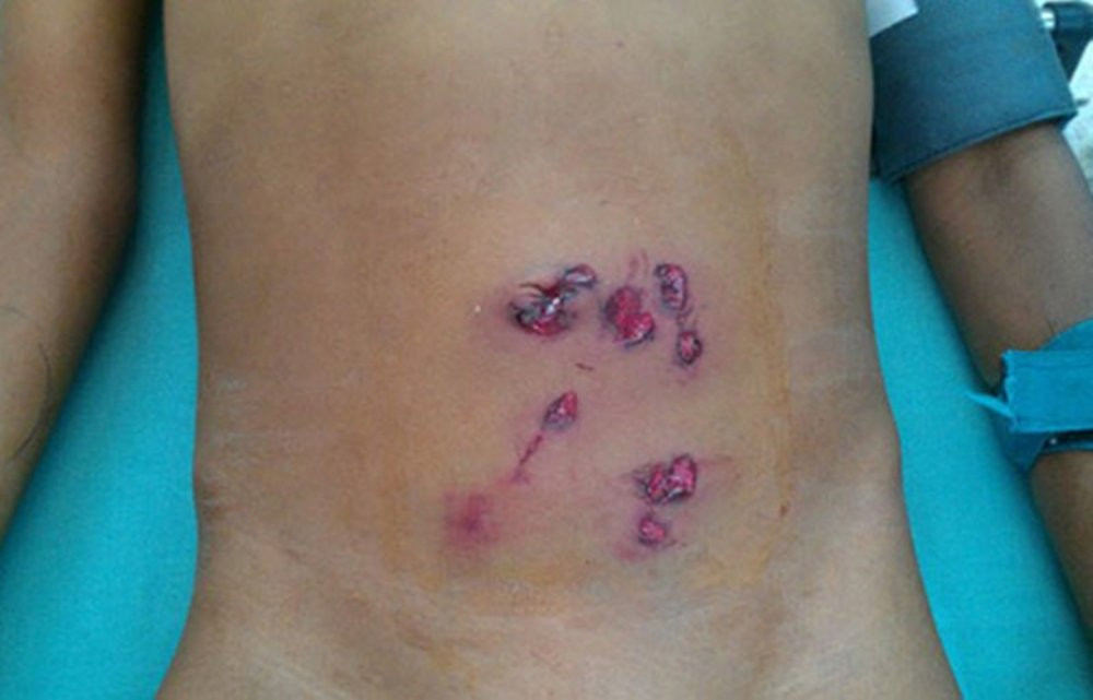 Những vết chọc hút mỡ bụng nếu không được thực hiện đúng kỹ thuật và đảm bảo vệ sinh an toàn sẽ gây nên nhiễm trùng.