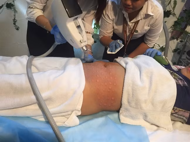 Chảy máu hoặc hút sát da gây hoại tử, nhiễm trùng là những biến chứng hút mỡ bụng mà các chị em phải đối mặt.