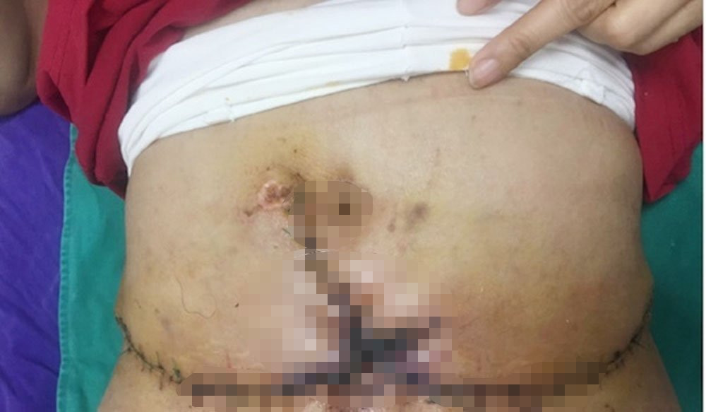 Sau khi được cắt mỡ bụng, dù người may mắn nhất cũng sẽ phải hứng chịu những vết mổ ngang với đường khâu dài, ảnh hưởng tới thẩm mỹ.