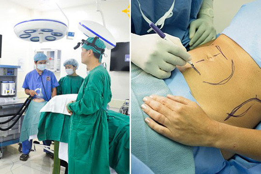 Theo quy định của Bộ Y tế, các cơ sở được cấp phép phẫu thuật thẩm mỹ chỉ được thực hiện tiểu phẫu gây tê tại chỗ. Riêng các "đại phẫu" như: nâng ngực; thu gọn thành bụng, mông, đùi; căng da mặt, mông, đùi; các thủ thuật bơm và hút mỡ cơ thể... chỉ các bệnh viện được cấp phép mới đủ điều kiện thực hiện. Tuy nhiên thực tế hiện nay còn rất nhiều cơ sở chưa đủ điều kiện cũng thực hiện hút mỡ bụng, điều này rất nguy hiểm.