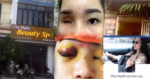 Spa Chu Huyen noi gi khi lam mu mat co gai tre tiem filler nang mui?