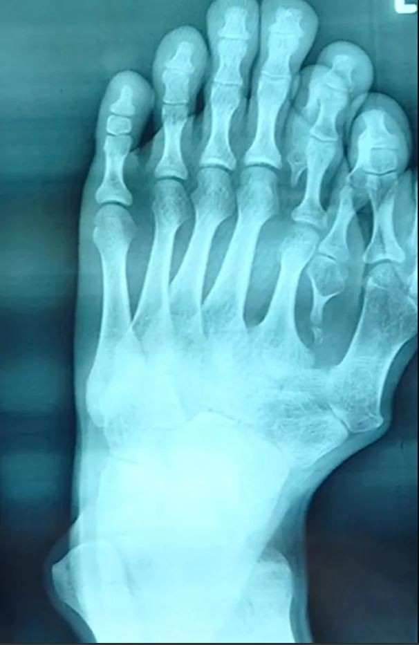 Hy huu chang trai co 9 ngon tren mot ban chan-Hinh-3