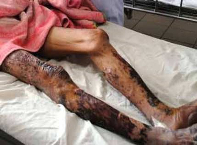 Theo bác sĩ, trong vài năm gần đầy, tỉ lệ mắc liên cầu lợn vào viện trong tình trạng nặng, diễn biến khó tiên lượng. Dù được cảnh báo nhiều về nguy hiểm chết người từ liên cầu khuẩn lợn, nhưng nhiều người vẫn chủ quan, sử dụng tiết canh lợn hoặc tiếp xúc với lợn bệnh nhưng không có bảo hộ. Nhiễm khuẩn liên cầu lợn để lại nhiều di chứng, thậm chí tử vong. 