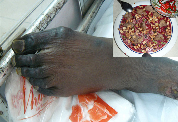 Có người gia đình nuôi lợn, thường xuyên giết mổ lợn và ăn tiết canh với lý do “lợn nhà nuôi nên an toàn”. Bằng mắt thường, người dân khó phân biệt con lợn nào có vi khuẩn liên cầu. Do vậy, việc ăn tiết canh lợn hoặc lợn chưa chế biến chín là cực kỳ nguy hiểm.