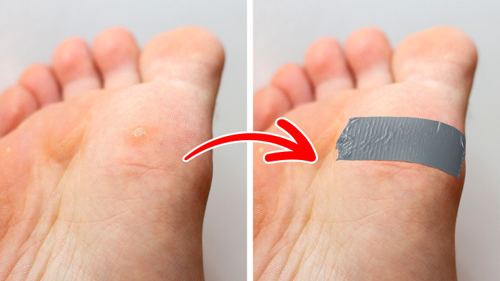 Băng keo cho mụn cóc: Khi bị mụn cóc bạn hãy vệ sinh sạch sẽ vùng da bị mụn, để khô rồi dán một miếng nhỏ băng dính che kín mụn. Sau khoảng 3 - 6 ngày bạn bóc băng dính, ngâm hoặc chườm da có mụn với nước ấm, sau đó dùng đá bọt chà nhẹ. Để da tiếp xúc với không khí qua đêm sau đó tiếp tục dán băng keo và thực hiện các bước như trên cho đến khi mụn biến mất. Ảnh: BS. Video "Bí quyết làm đẹp của sao Việt". Nguồn: VTC.