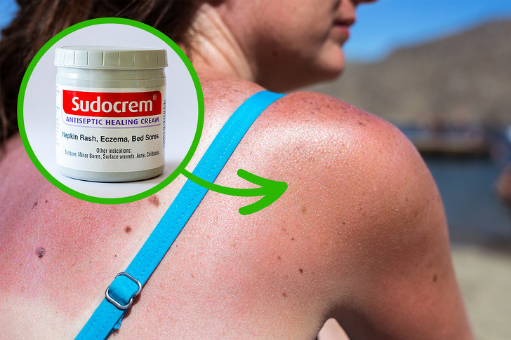 Sudocrem làm dịu làn da cháy nắng: Sau khi đi nắng, làm việc lâu ngoài trời bạn có thể sử dụng kem trị hăm trẻ em Sudocrem để làm dịu da. Sản phẩm này cũng có khả năng ngừa sẹo cho các vết bỏng nhẹ. 