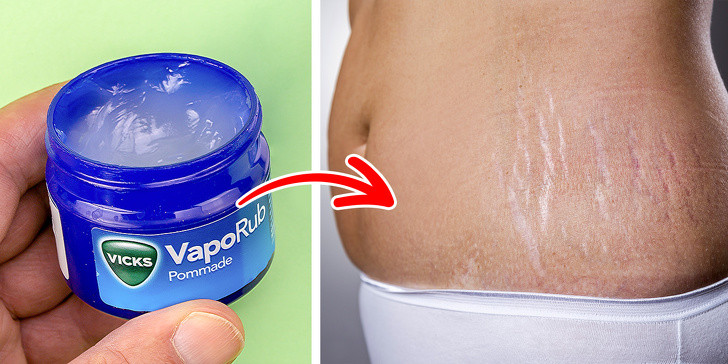 Kem mỡ VapoRub trị rạn da: Rạn da là tình trạng thường gặp ở phụ nữ sau sinh hoặc người tăng/ giảm cân đột ngột. Dù không dễ dàng để loại bỏ các vết rạn này trên cơ thể, song bạn có thể dùng kem mỡ VapoRub, có thành phần chủ yếu là bạch đàn, lá tuyết tùng, long não,... giúp làm ẩm và cải thiện độ đàn hồi da hiệu quả.
