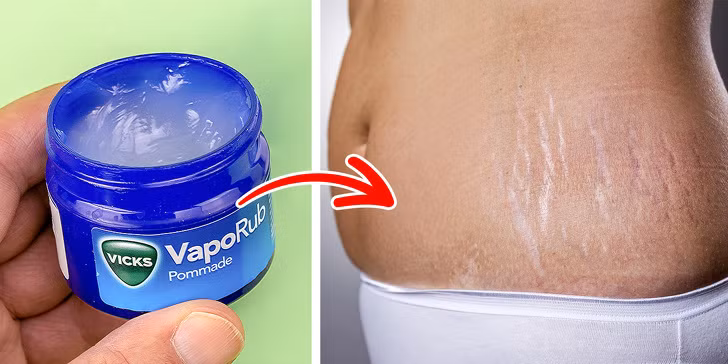 Kem mỡ VapoRub trị rạn da: Rạn da là tình trạng thường gặp ở phụ nữ sau sinh hoặc người tăng/ giảm cân đột ngột. Dù không dễ dàng để loại bỏ các vết rạn này trên cơ thể, song bạn có thể dùng kem mỡ VapoRub, có thành phần chủ yếu là bạch đàn, lá tuyết tùng, long não,... giúp làm ẩm và cải thiện độ đàn hồi da hiệu quả.