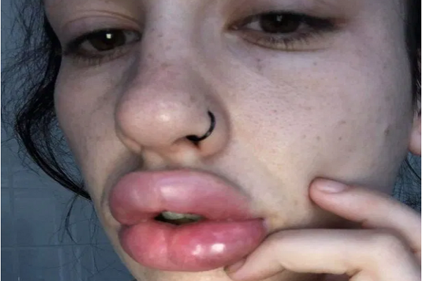 Tiêm chất filler trôi nổi, kém chất lượng thì sẽ lập tức có các hiện tượng như: đông cứng và vón cục, môi sẽ thiếu đi sự mềm mại mà thay vào đó là cứng đơ, mất cảm giác. Và cũng theo bác sỹ, tác dụng kéo dài của chất làm đầy thường là 6 đến 9 tháng hoặc hơn 1 năm chứ không vĩnh viễn như nhiều người lầm tưởng. 