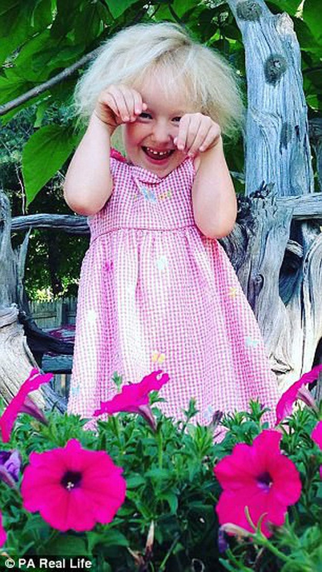 Đây là một hội chứng ảnh hưởng tới 100/7,7 tỷ người trên toàn thế giới là một nỗi lo của nhiều nhà nghiên cứu y khoa. Người mắc phải hội chứng Uncombable Hair thường có mái tóc màu ánh kim hoặc bạch kim.