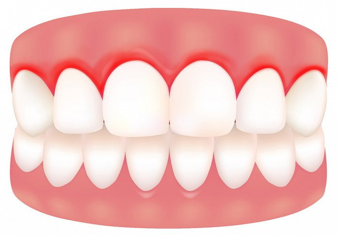 Nướu sưng, chảy máu: Vitamin C là nền tảng cho sức khỏe của nướu, nếu không được chăm sóc thích hợp, nướu sẽ bị viêm, sưng. Tuy nhiên, nếu làm tốt bước đó mà nướu vẫn sưng thì có thể cơ thể bạn đang thiếu vitamin C trầm trọng.