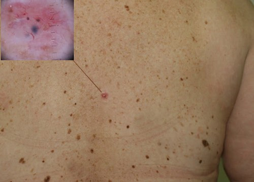 Khi kiểm tra cần thực hiện từ trước ra sau, từ trên xuống dưới. Ngoài những nốt ruồi, bạn cần đặc biệt chú ý đến vết mụn, loét, tàn nhang, dấu hiệu bất thường ở mũi, môi, miệng, tai.