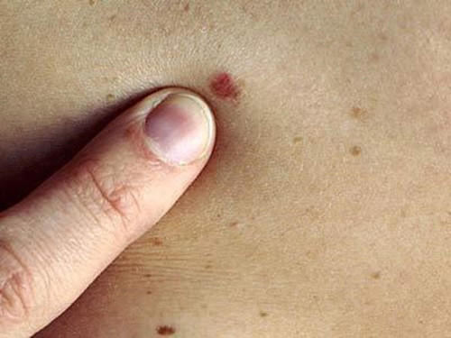 Lưu lại hình ảnh ở mắt cá, gan – bàn chân, giữa các ngón cái và phần ở gần móng. Đặc biệt chú ý đến những dấu hiệu bất thường nào ở bộ phận sinh dục.