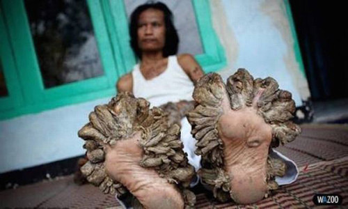 Đột biến mọc sừng. Cho tới thời điểm hiện tại chỉ có 195 trường hợp cơ thể đột biến mọc sừng cơ thể được ghi nhận. Nguyên nhân của những “khách không mời” bắt nguồn từ việc cơ thể quá nhạy cảm với vi rút HPV.