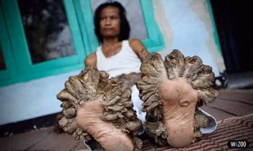 Đột biến mọc sừng. Cho tới thời điểm hiện tại chỉ có 195 trường hợp cơ thể đột biến mọc sừng cơ thể được ghi nhận. Nguyên nhân của những “khách không mời” bắt nguồn từ việc cơ thể quá nhạy cảm với vi rút HPV.