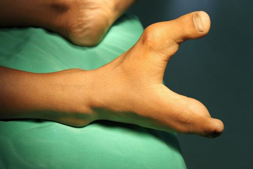 Hội chứng càng tôm hùm. Người bị ectrodactyly thường có một khe hở nơi lẽ ra là chỗ của ngón (tay hay chân) giữa. Chứng bệnh khiến cho hình dạng bàn tay hay bàn chân tựa như chiếc càng tôm hùm.