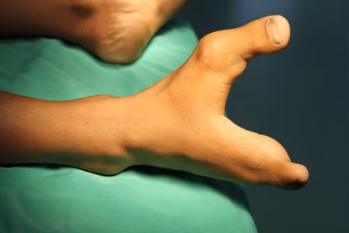 Hội chứng càng tôm hùm. Người bị ectrodactyly thường có một khe hở nơi lẽ ra là chỗ của ngón (tay hay chân) giữa. Chứng bệnh khiến cho hình dạng bàn tay hay bàn chân tựa như chiếc càng tôm hùm.