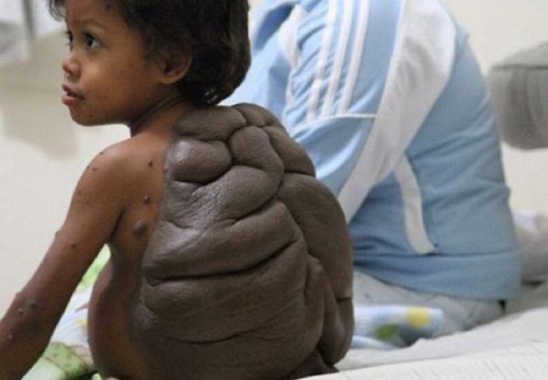 Hội chứng Proteus. Cơ thể người mắc Proteus có xương, da hoặc các nốt sần tăng trưởng khá nhanh, không tương xứng với những bộ phận còn lại. Điều này khiến họ thường xuyên kết bạn với biệt danh “người voi” cùng ánh nhìn không mấy thân thiện từ những người xung quanh.